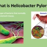 5 Ways to Treat H Pylori the Natural Way