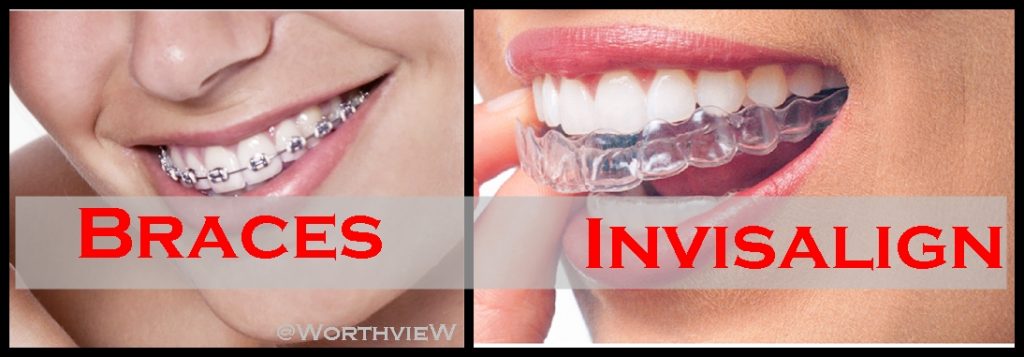 The Pros And Cons Of Invisalign Vs Braces Worthview