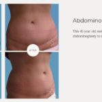 What is a Tummy Tuck?