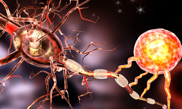 How Does Primary Progressive Multiple Sclerosis Differ From Other Diagnoses?