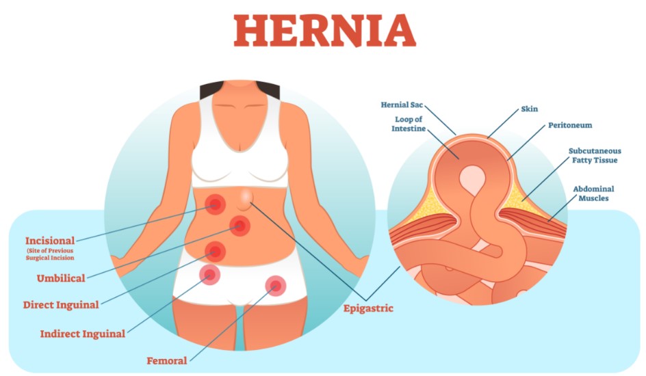 Hernia