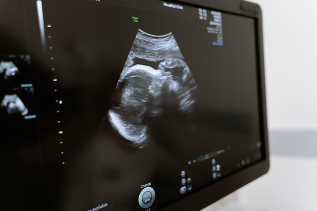 What You Need to Know About Sonograms