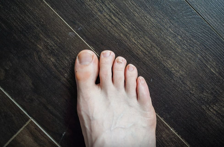 Toenail Fungus vs. Athlete’s Foot: What’s the Difference?