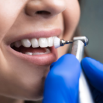 Understanding The Full Scope: What Is Included In A Dental Cleaning?