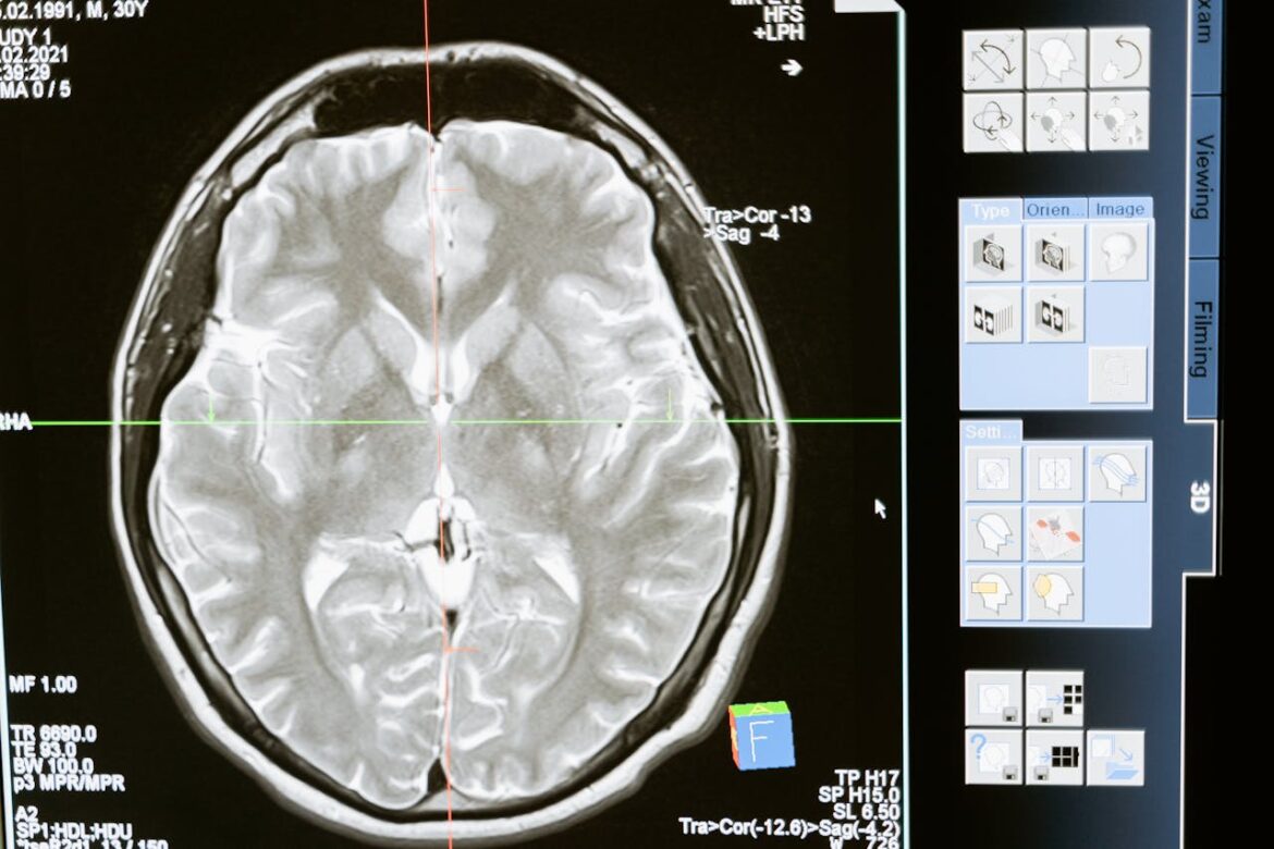 Chronic Traumatic Encephalopathy (CTE) and Its Link to Untreated Concussions in the Workplace