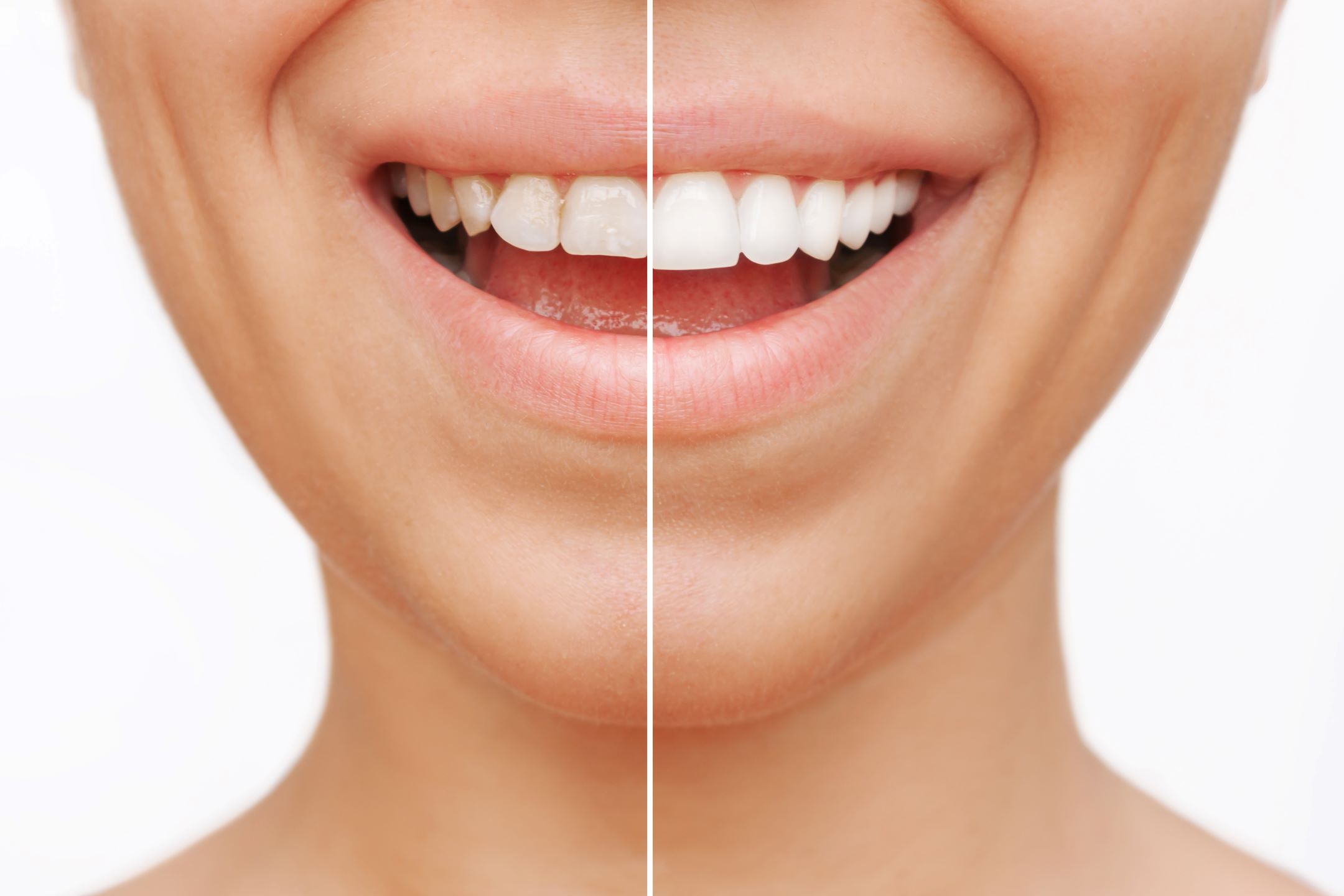 Types Of Dental Veneers