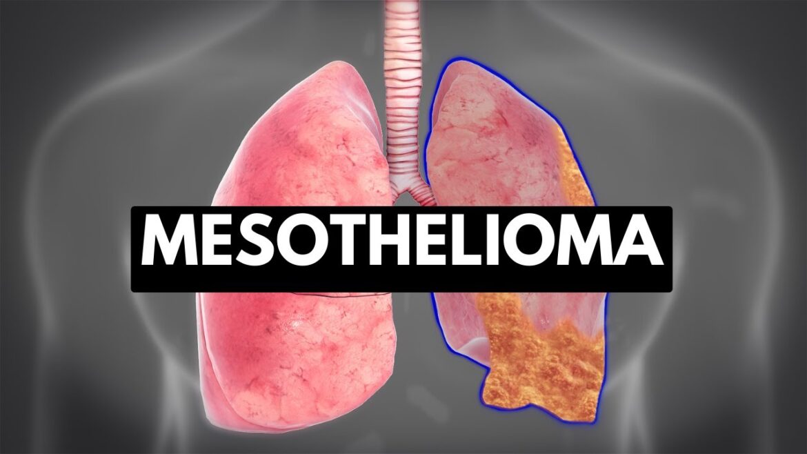 When Should You Get Tested for Mesothelioma?