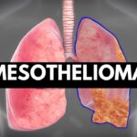 Mesothelioma